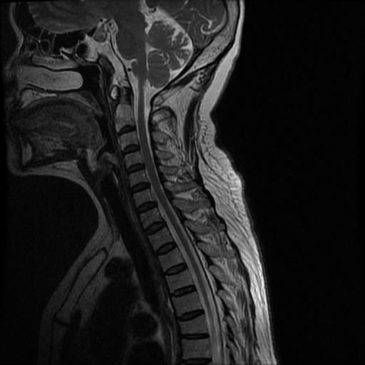 C#处理医学影像(四):基于Stitcher算法拼接人体全景脊柱骨骼影像
